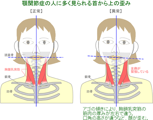 顎関節症の人に多く見られる首から上の歪み