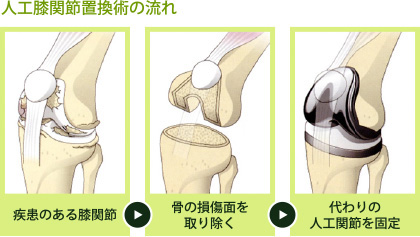 人口膝関節置換術の流れ