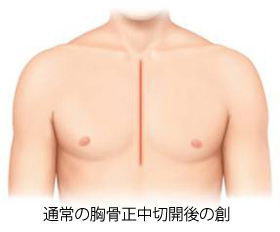 通常の胸骨正中切開後の創