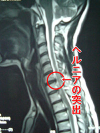 頸椎ヘルニア