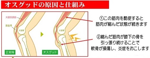 オスグッドの原因と仕組み