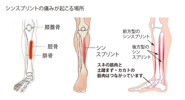 シンスプリントの痛みが起こる場所