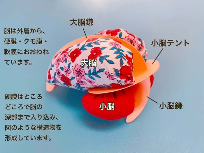 大脳鎌 テント膜