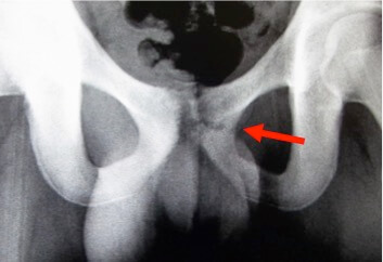 恥骨　疲労骨折